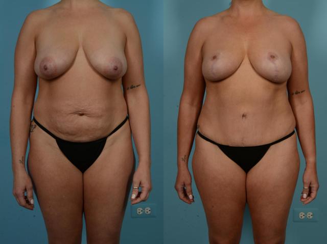 Mommy Makeover result at TLKM Plastic Surgery (Sammy Sinno, MD) in Chicago, IL