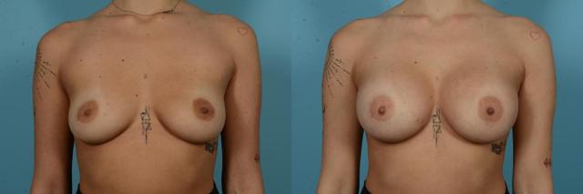 Breast Augmentation result at TLKM Plastic Surgery (Sammy Sinno, MD) in Chicago, IL