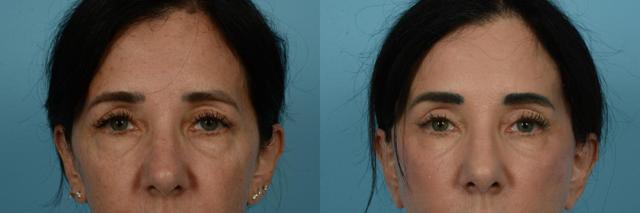 Brow Lift result at TLKM Plastic Surgery (Sammy Sinno, MD) in Chicago, IL