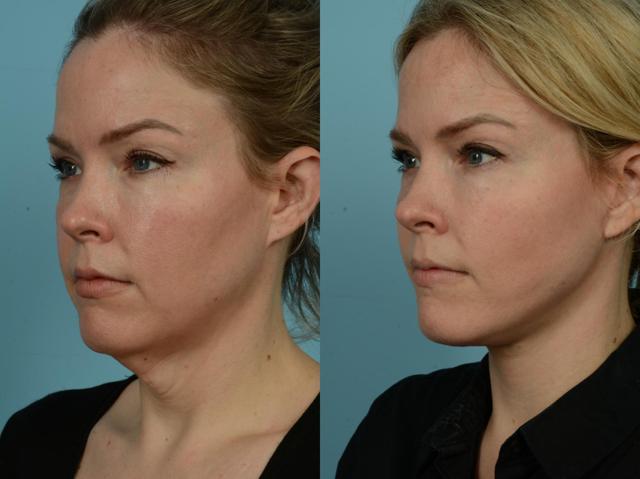 Neck Lift result at TLKM Plastic Surgery (Sammy Sinno, MD) in Chicago, IL