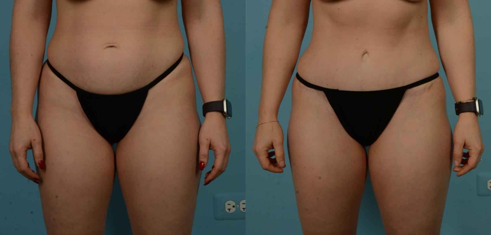 TLKM Plastic Surgery (Sammy Sinno, MD) tummy tuck result — Chicago, IL