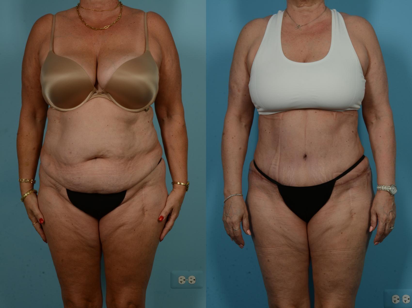 TLKM Plastic Surgery (Sammy Sinno, MD) tummy tuck result — Chicago, IL