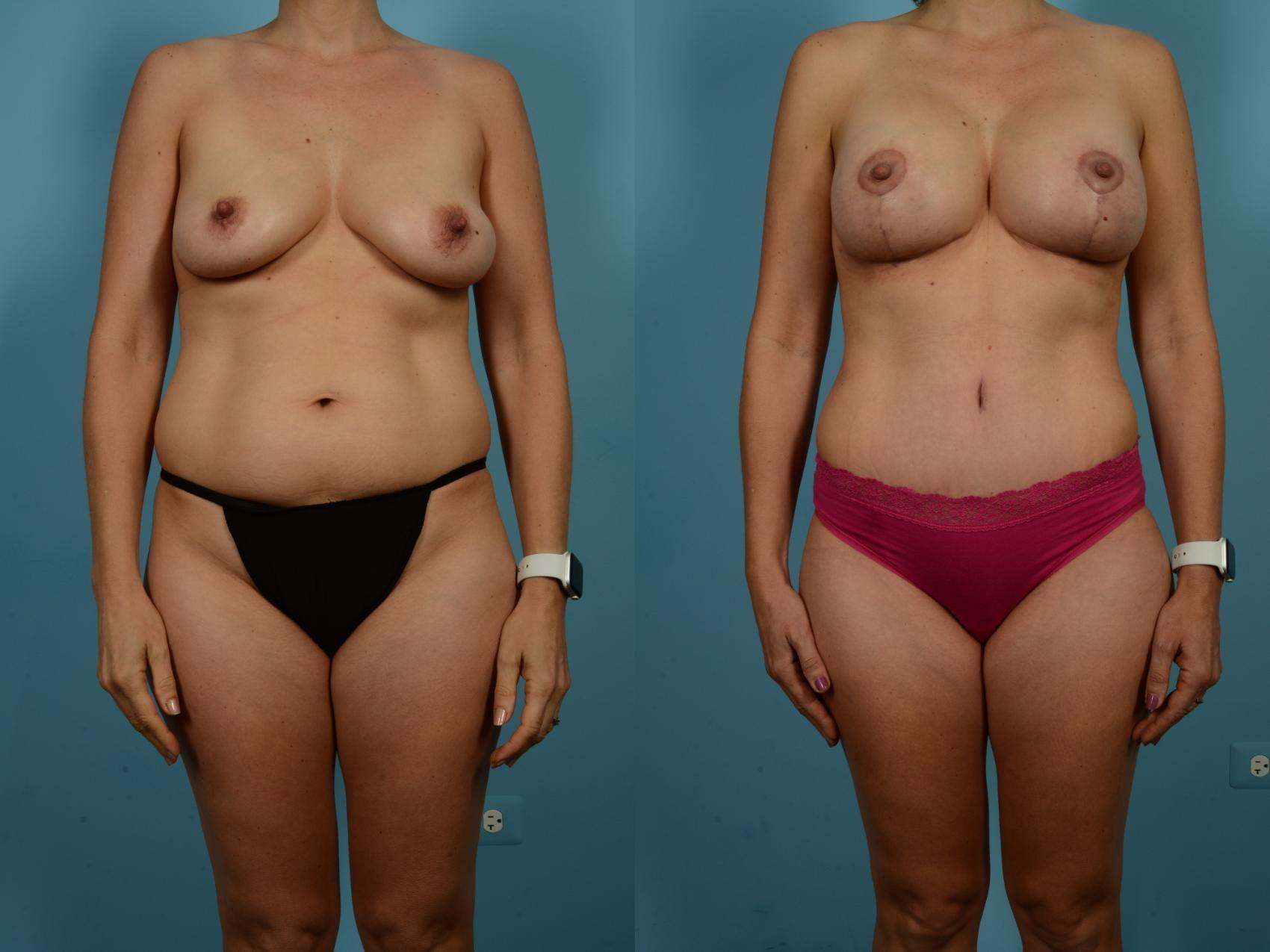 TLKM Plastic Surgery (Sammy Sinno, MD) mommy makeover result — Chicago, IL