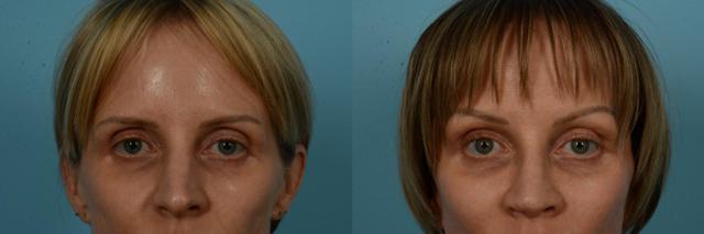 Brow Lift result at TLKM Plastic Surgery (Sammy Sinno, MD) in Chicago, IL