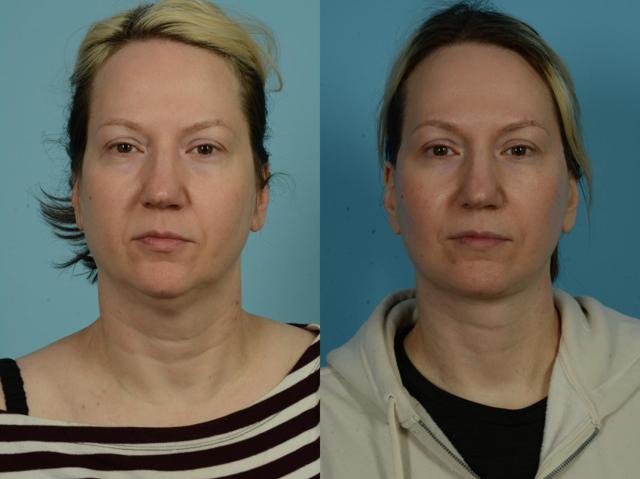Neck Lift result at TLKM Plastic Surgery (Sammy Sinno, MD) in Chicago, IL