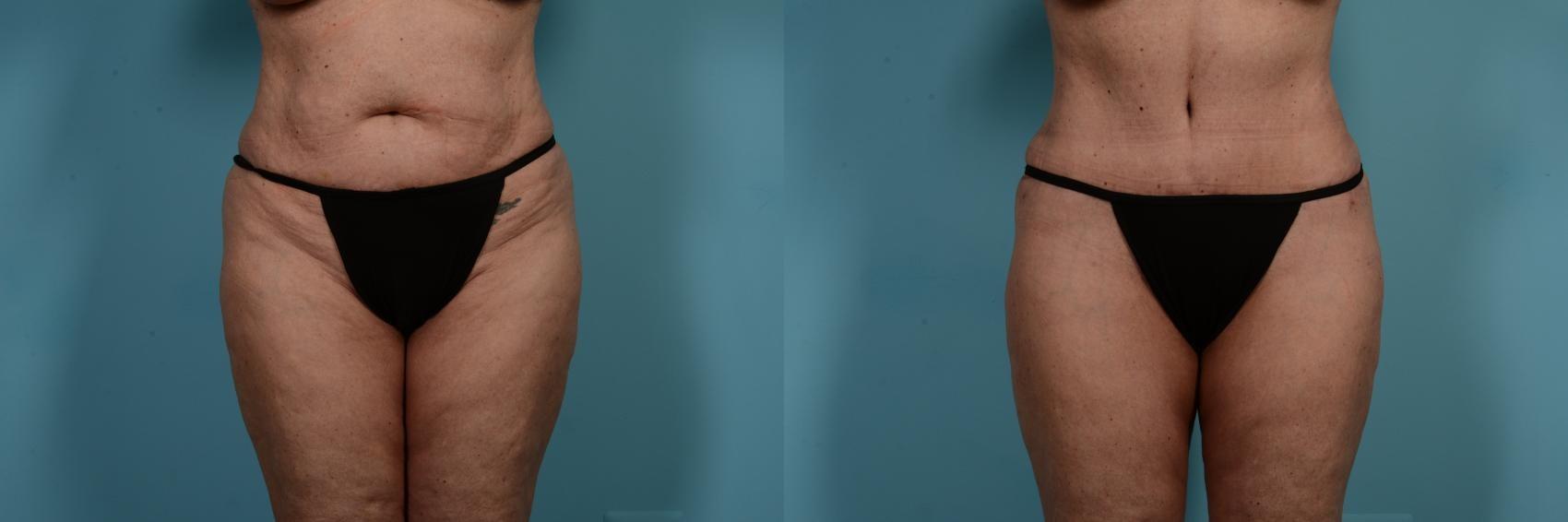 TLKM Plastic Surgery (Sammy Sinno, MD) tummy tuck result — Chicago, IL
