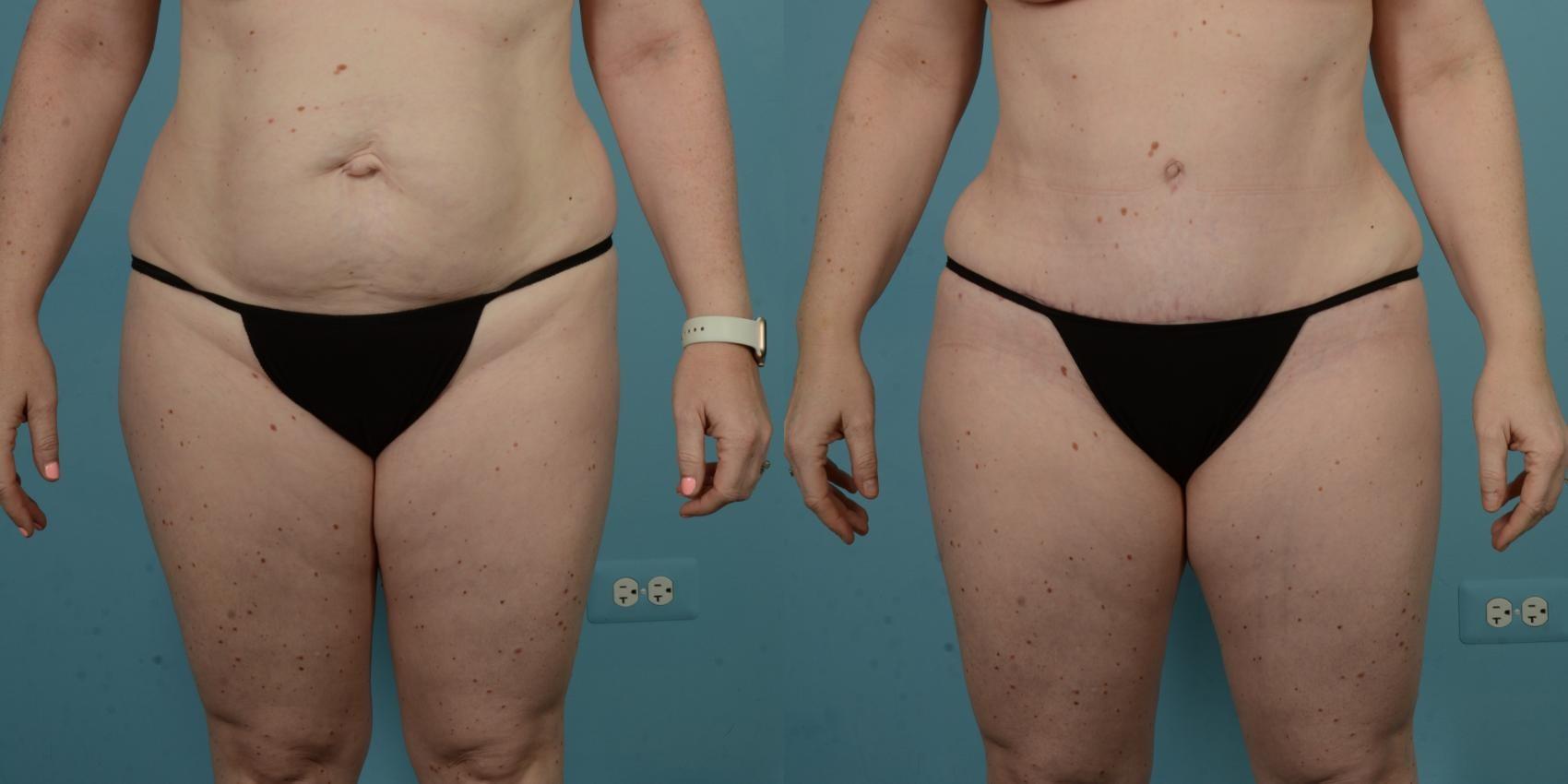 TLKM Plastic Surgery (Sammy Sinno, MD) tummy tuck result — Chicago, IL