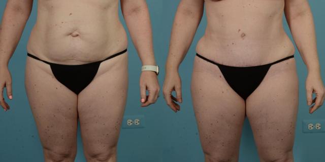 Tummy Tuck result at TLKM Plastic Surgery (Sammy Sinno, MD) in Chicago, IL