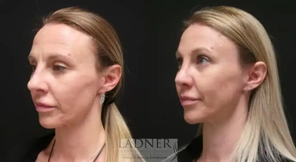 Ladner Facial Plastic Surgery brow lift result — Greenwood Village, CO