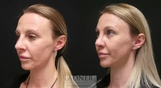 Brow Lift result at Ladner Facial Plastic Surgery in Greenwood Village, CO