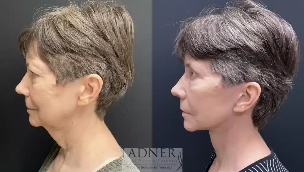Ladner Facial Plastic Surgery facelift result — Greenwood Village, CO