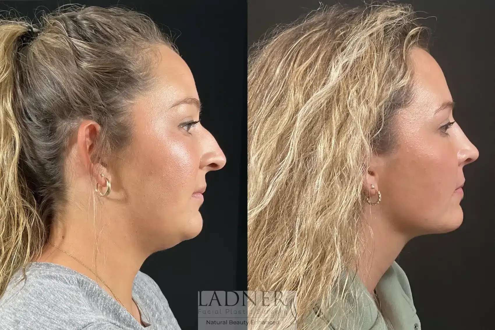 Ladner Facial Plastic Surgery rhinoplasty result — Greenwood Village, CO