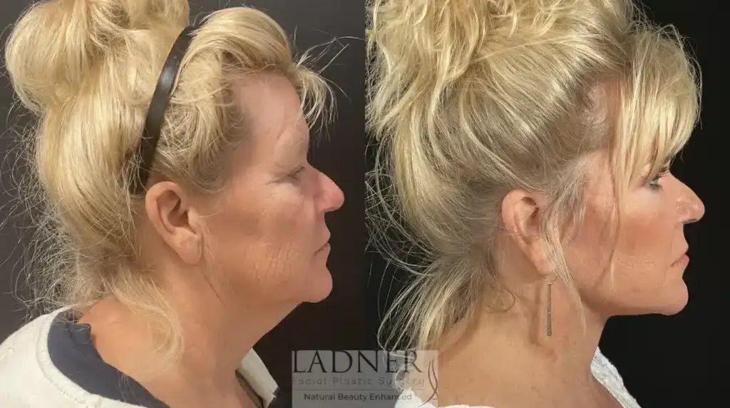 Ladner Facial Plastic Surgery facelift result — Greenwood Village, CO