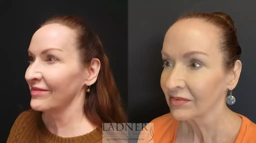 Ladner Facial Plastic Surgery facelift result — Greenwood Village, CO