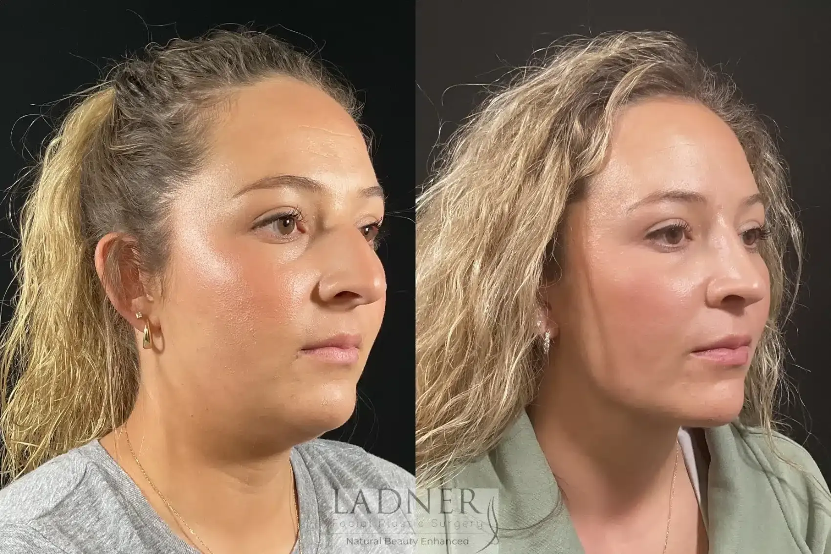 Ladner Facial Plastic Surgery rhinoplasty result — Greenwood Village, CO