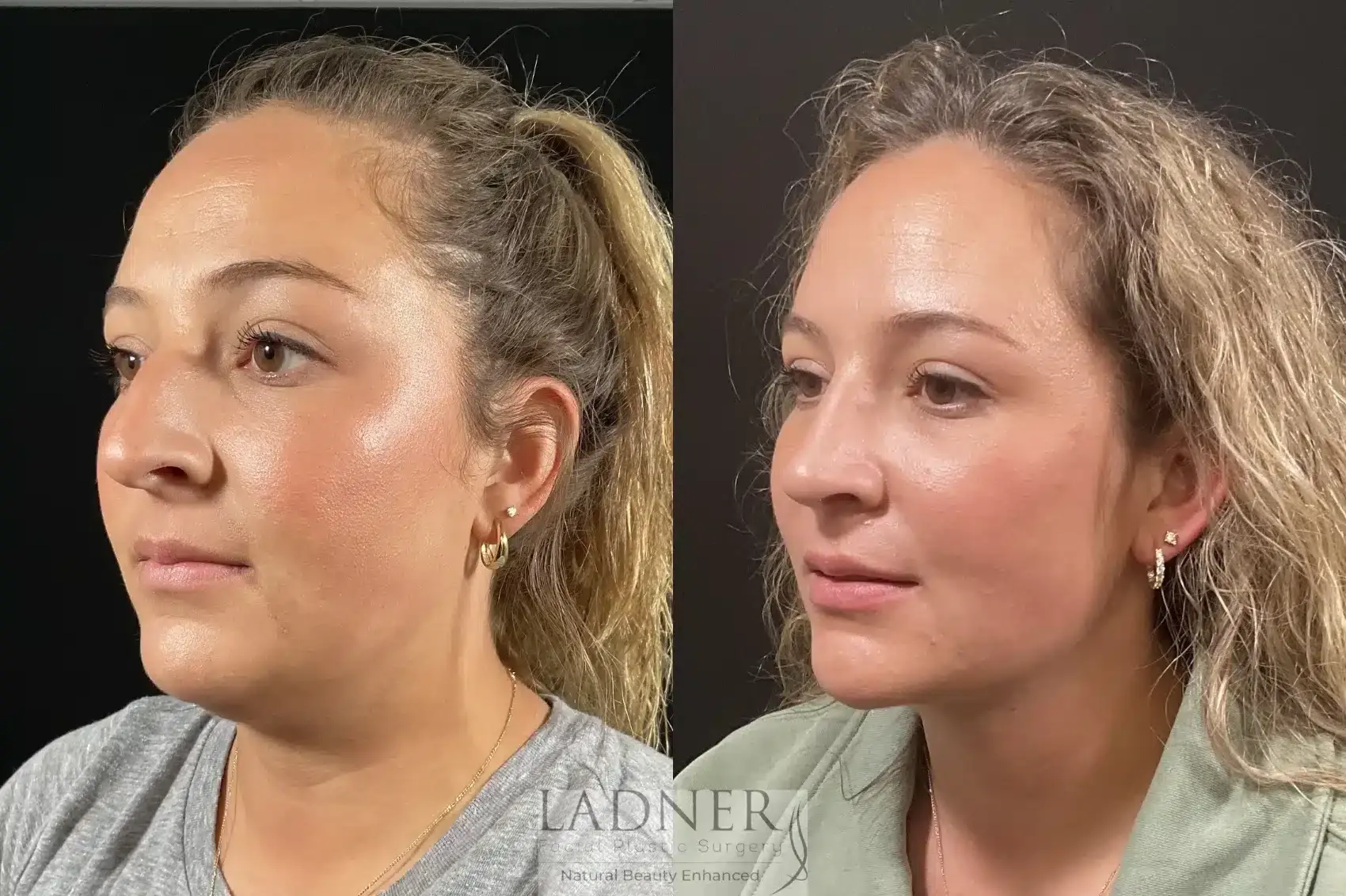 Ladner Facial Plastic Surgery rhinoplasty result — Greenwood Village, CO