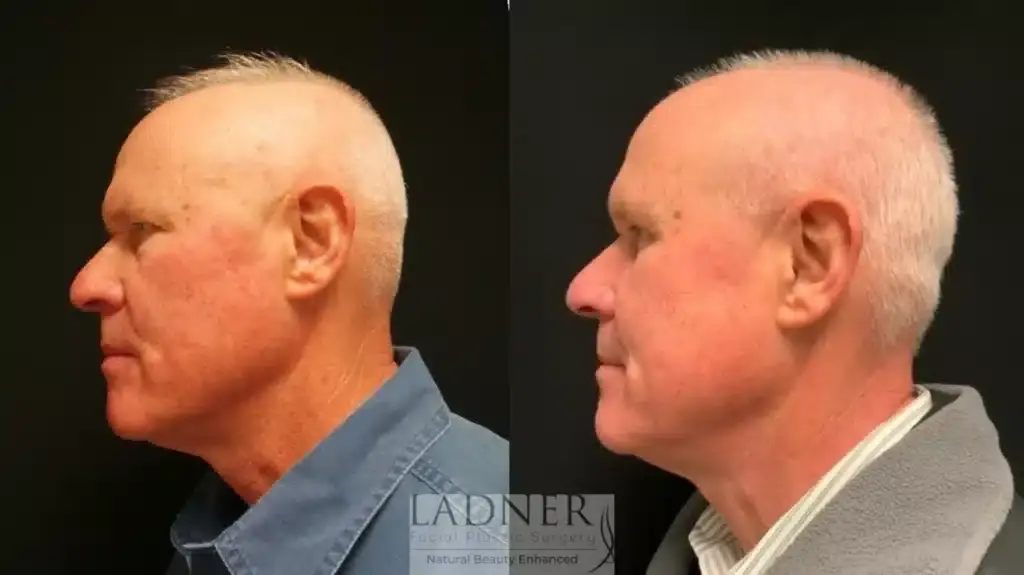 Ladner Facial Plastic Surgery blepharoplasty result — Greenwood Village, CO