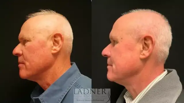 Blepharoplasty result at Ladner Facial Plastic Surgery in Greenwood Village, CO