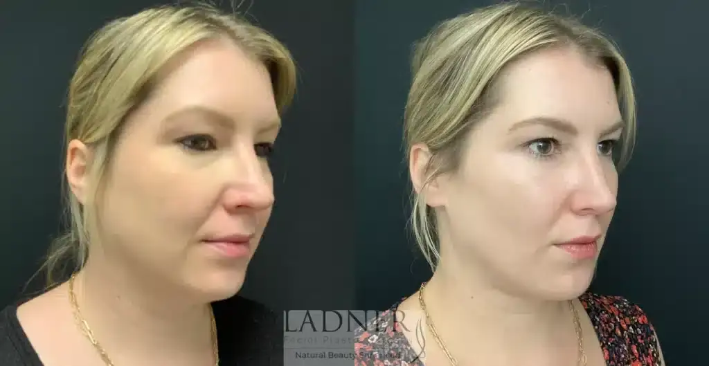 Ladner Facial Plastic Surgery facelift result — Greenwood Village, CO