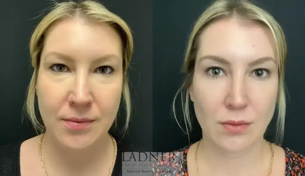 Ladner Facial Plastic Surgery facelift result — Greenwood Village, CO