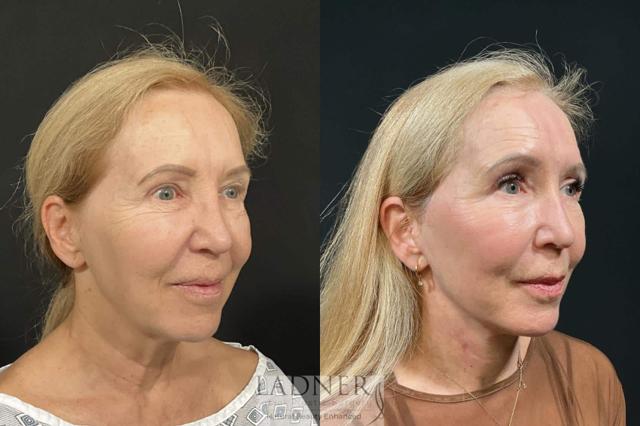 Deep Plane Facelift result at Ladner Facial Plastic Surgery in Greenwood Village, CO