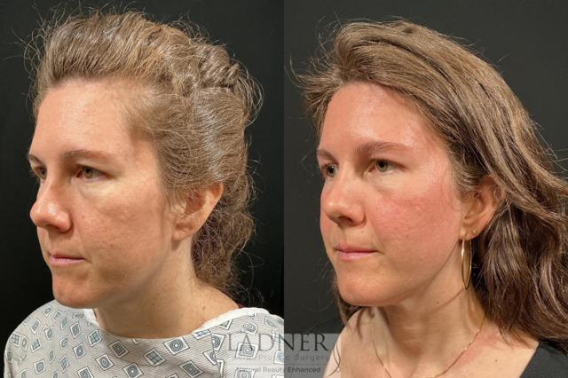 Brow Lift result at Ladner Facial Plastic Surgery in Greenwood Village, CO