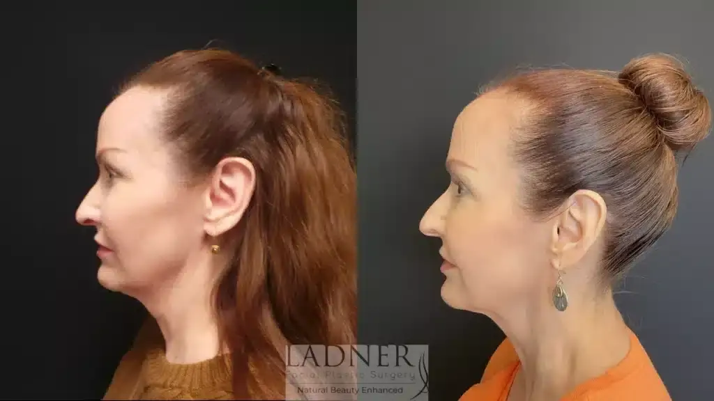 Ladner Facial Plastic Surgery facelift result — Greenwood Village, CO