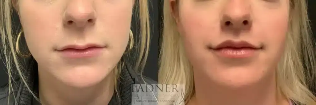 Ladner Facial Plastic Surgery facelift result — Greenwood Village, CO