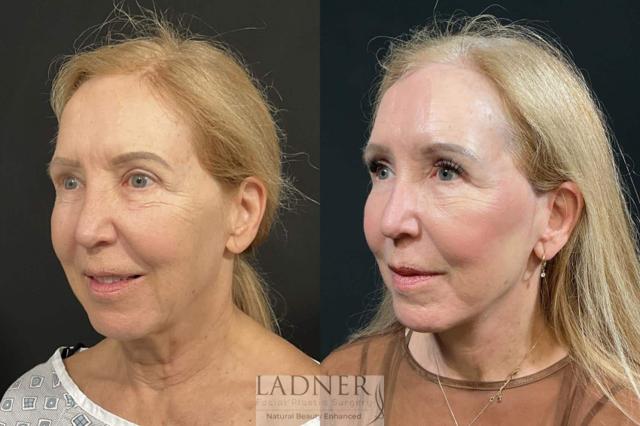 Deep Plane Facelift result at Ladner Facial Plastic Surgery in Greenwood Village, CO