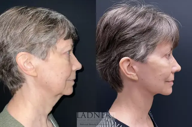 Deep Plane Facelift result at Ladner Facial Plastic Surgery in Greenwood Village, CO
