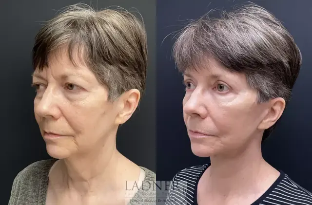 Deep Plane Facelift result at Ladner Facial Plastic Surgery in Greenwood Village, CO