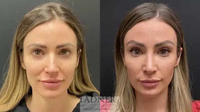 Brow Lift result at Ladner Facial Plastic Surgery in Greenwood Village, CO