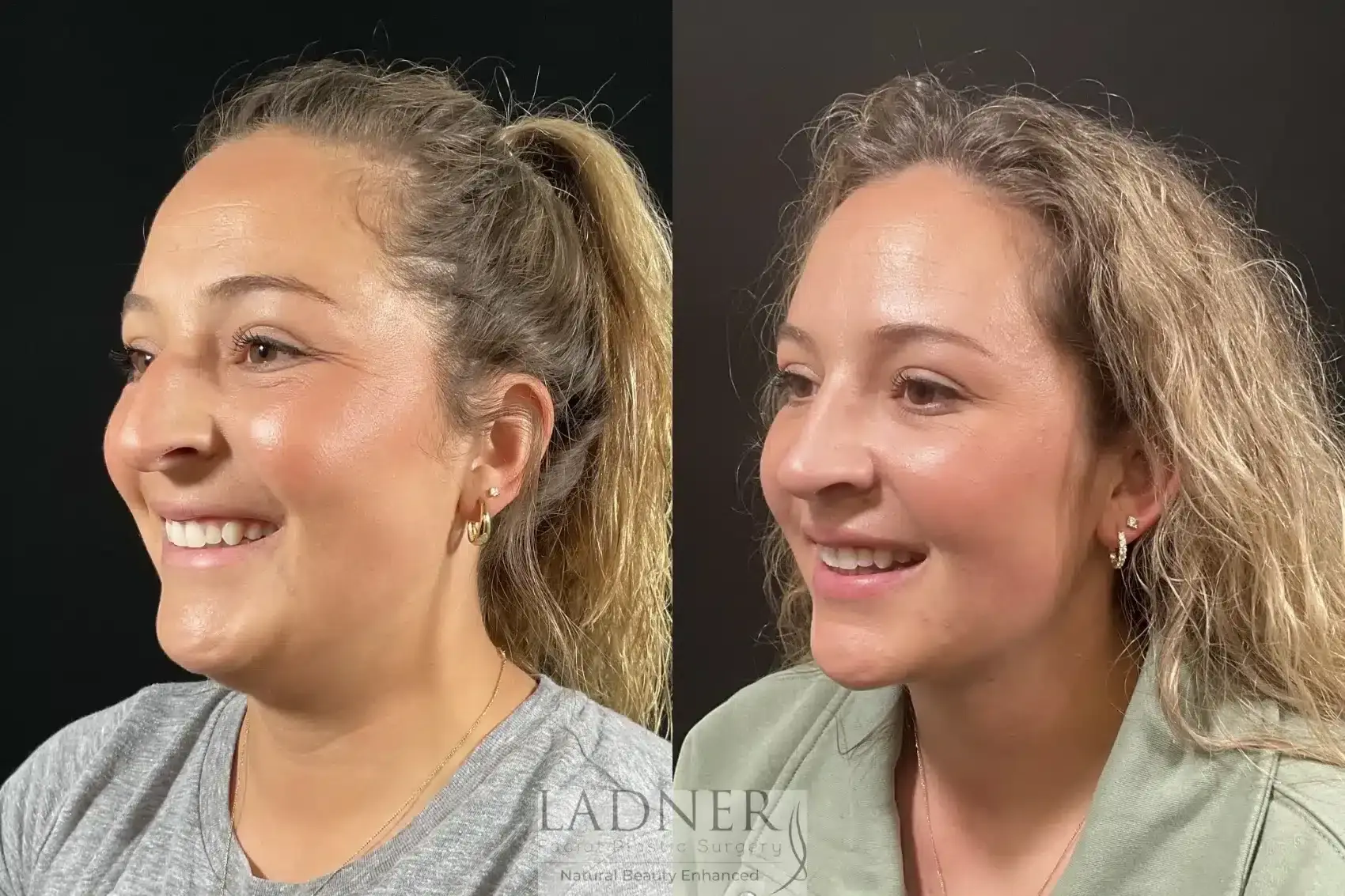Ladner Facial Plastic Surgery rhinoplasty result — Greenwood Village, CO