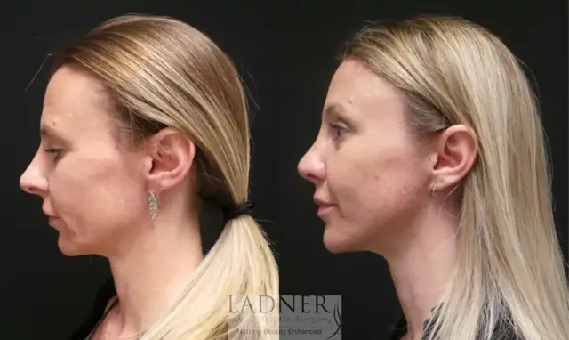 Brow Lift result at Ladner Facial Plastic Surgery in Greenwood Village, CO