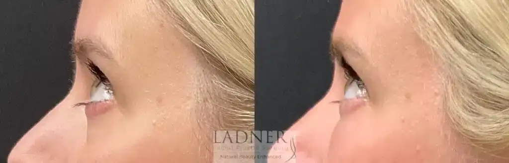 Ladner Facial Plastic Surgery facelift result — Greenwood Village, CO