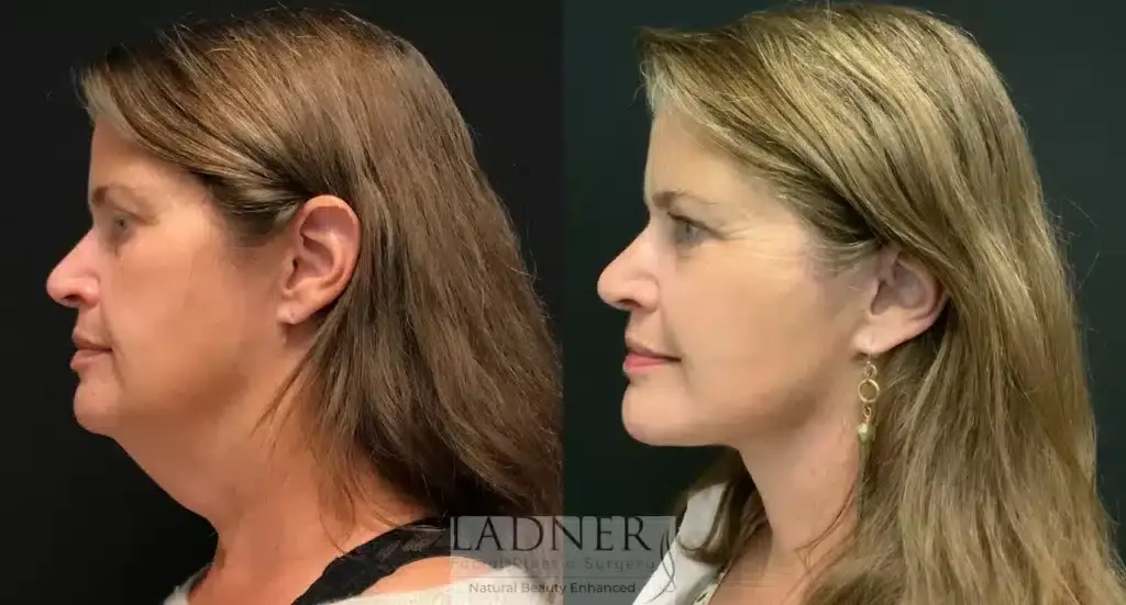 Ladner Facial Plastic Surgery facelift result — Greenwood Village, CO