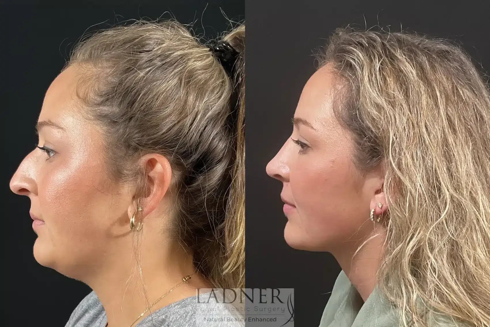 Ladner Facial Plastic Surgery rhinoplasty result — Greenwood Village, CO
