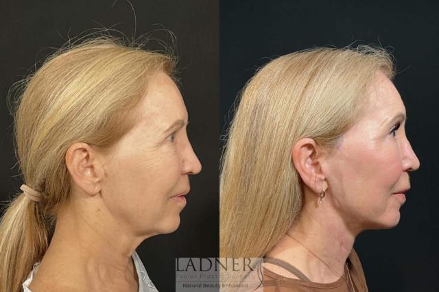 Deep Plane Facelift result at Ladner Facial Plastic Surgery in Greenwood Village, CO