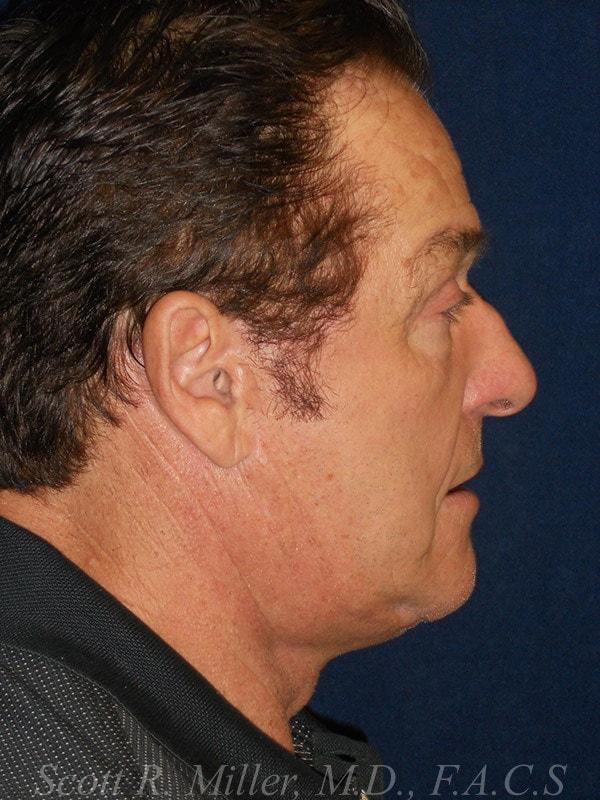 Facelift after at Miller Cosmetic Surgery Center - Scott R. Miller, MD, FACS in San Diego, CA