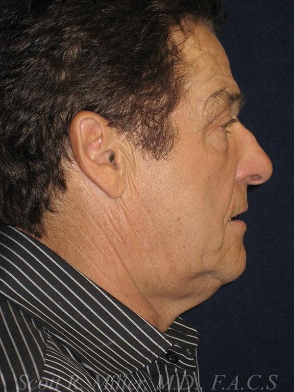 Facelift before at Miller Cosmetic Surgery Center - Scott R. Miller, MD, FACS in San Diego, CA