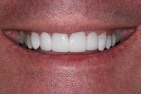 St. George Dental Care veneers after — St. George, UT