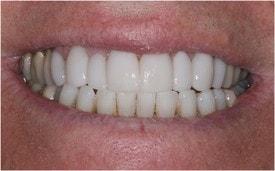 St. George Dental Care veneers after — St. George, UT