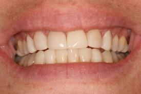 Dental Implants after at St. George Dental Care in St. George, UT