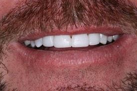 St. George Dental Care veneers after — St. George, UT