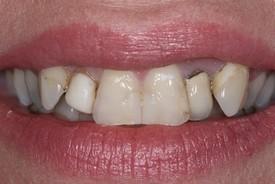 Dental Veneers before at St. George Dental Care in St. George, UT
