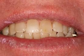 Dental Veneers before at St. George Dental Care in St. George, UT