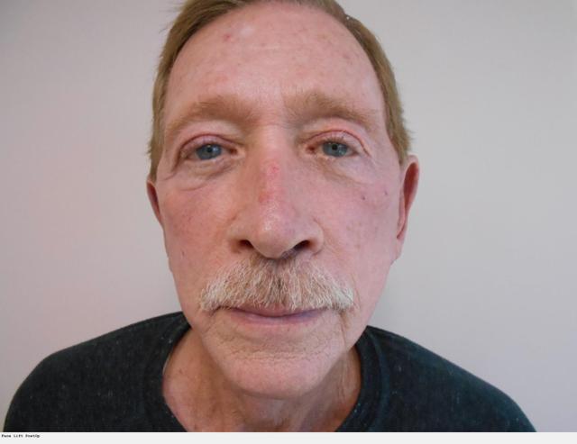 Facelift after at Ralph Massey, MD in Los Angeles, CA