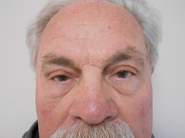 Ralph Massey, MD eyelid lift after — Los Angeles, CA