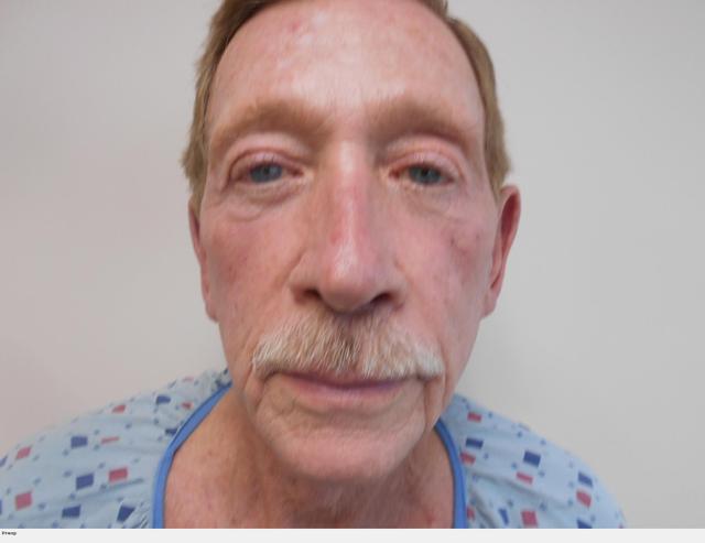 Facelift before at Ralph Massey, MD in Los Angeles, CA