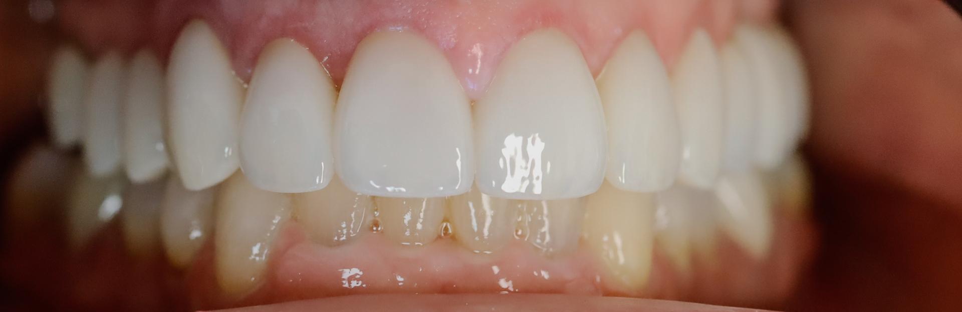 Birdwell & Mutlak Dentistry smile makeover after — Thompson's Station, TN